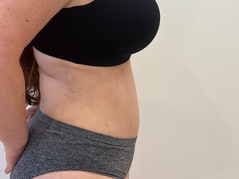 Tummy Tuck Before & After Gallery - Patient 300485 - Image 6
