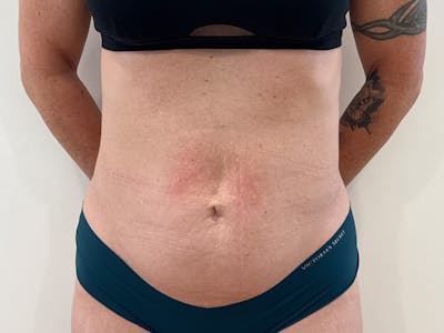 Tummy Tuck Before & After Gallery - Patient 266235 - Image 1