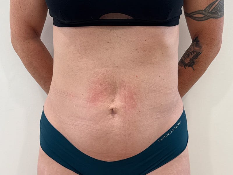 Tummy Tuck Before & After Gallery - Patient 266235 - Image 1