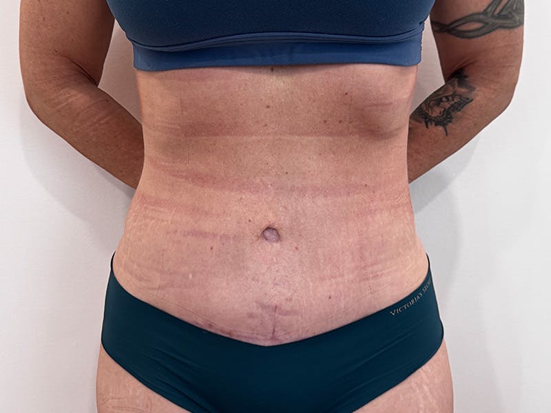 Tummy Tuck Before & After Gallery - Patient 266235 - Image 2