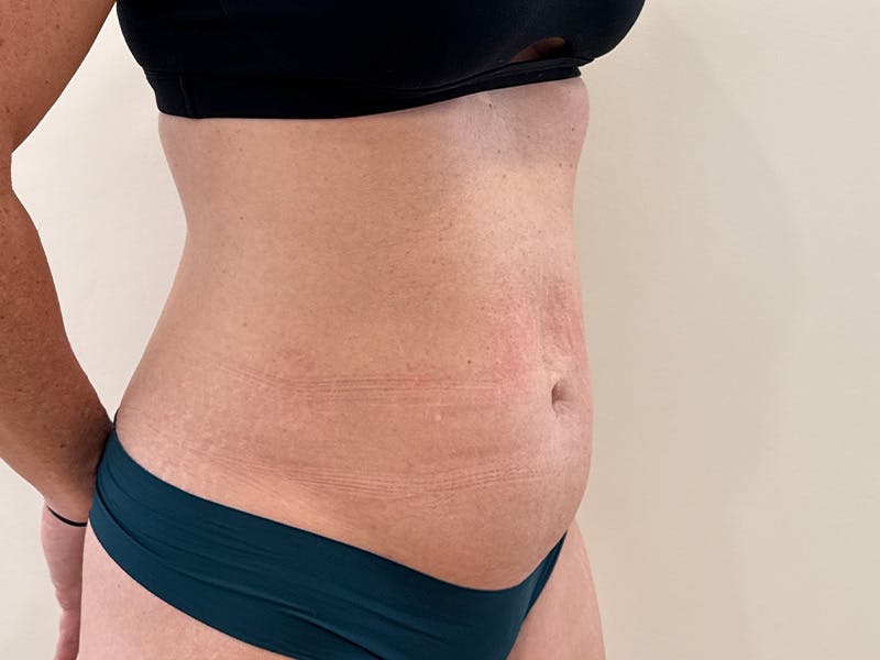 Tummy Tuck Before & After Gallery - Patient 266235 - Image 3