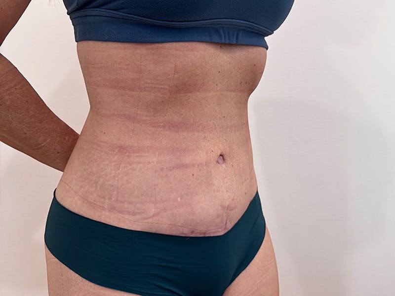 Tummy Tuck Before & After Gallery - Patient 266235 - Image 4