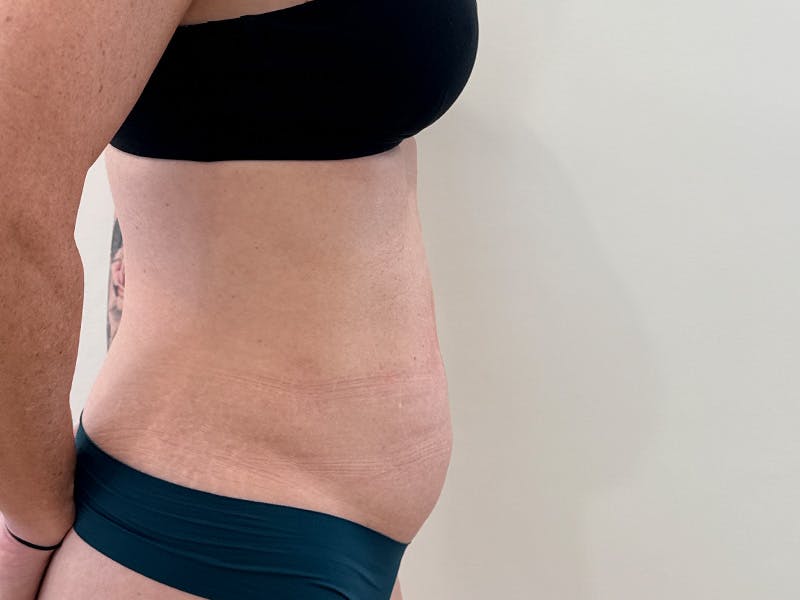 Tummy Tuck Before & After Gallery - Patient 266235 - Image 5
