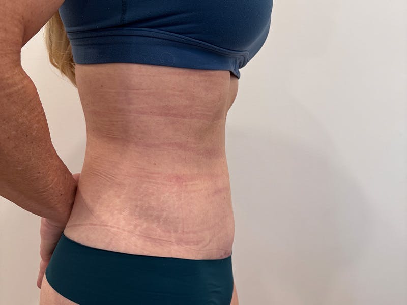 Tummy Tuck Before & After Gallery - Patient 266235 - Image 6