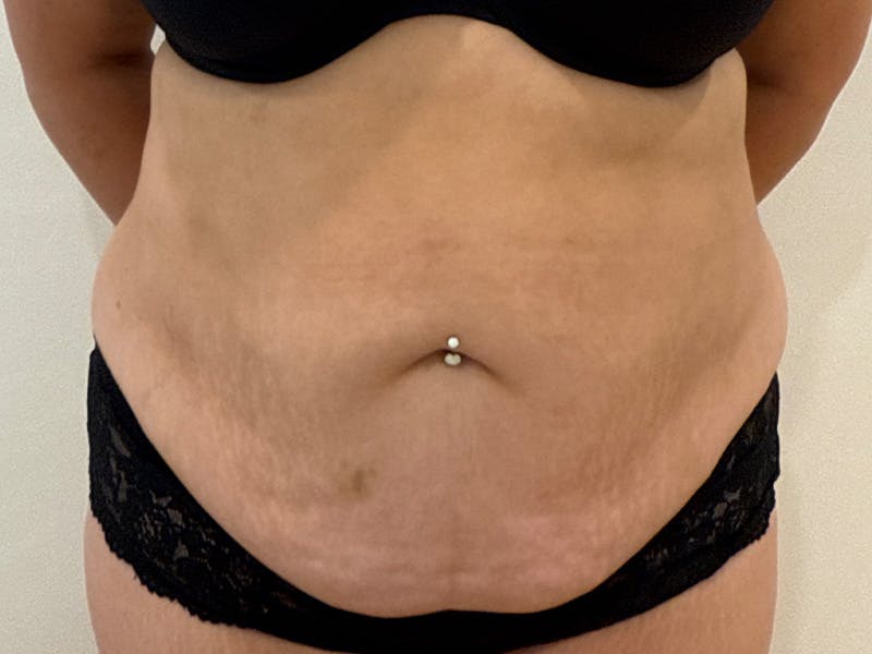 Tummy Tuck Before & After Gallery - Patient 271350 - Image 1