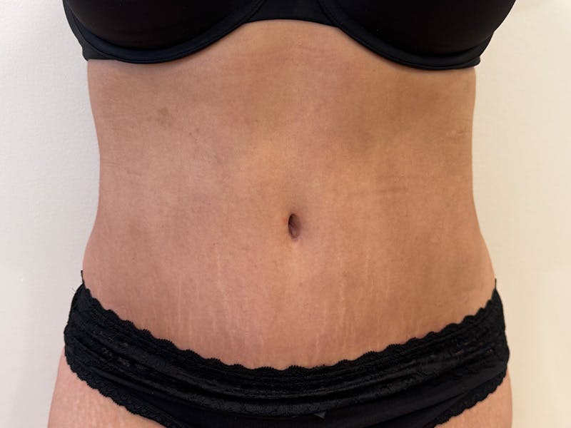 Tummy Tuck Before & After Gallery - Patient 271350 - Image 2