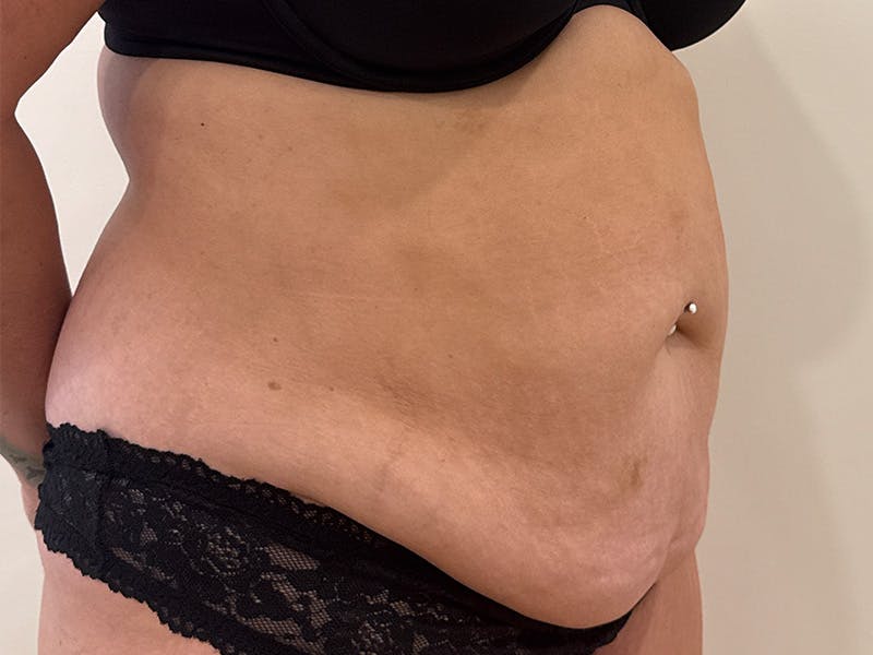 Tummy Tuck Before & After Gallery - Patient 271350 - Image 3