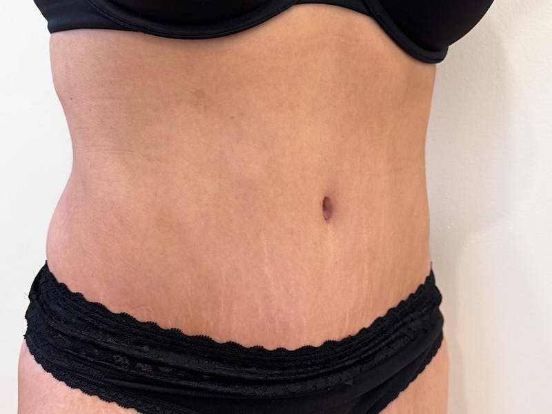 Tummy Tuck Before & After Gallery - Patient 271350 - Image 4