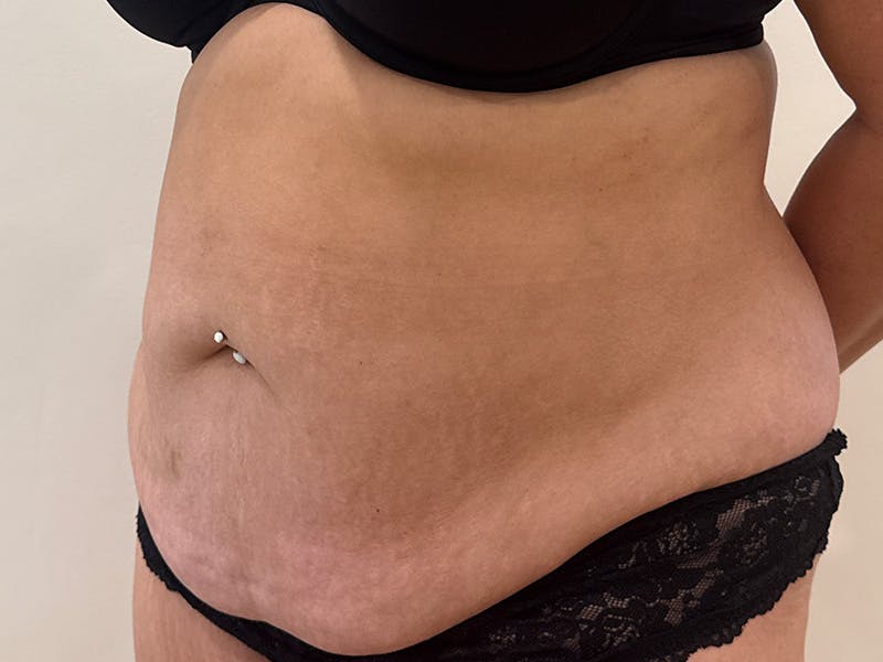 Tummy Tuck Before & After Gallery - Patient 271350 - Image 5