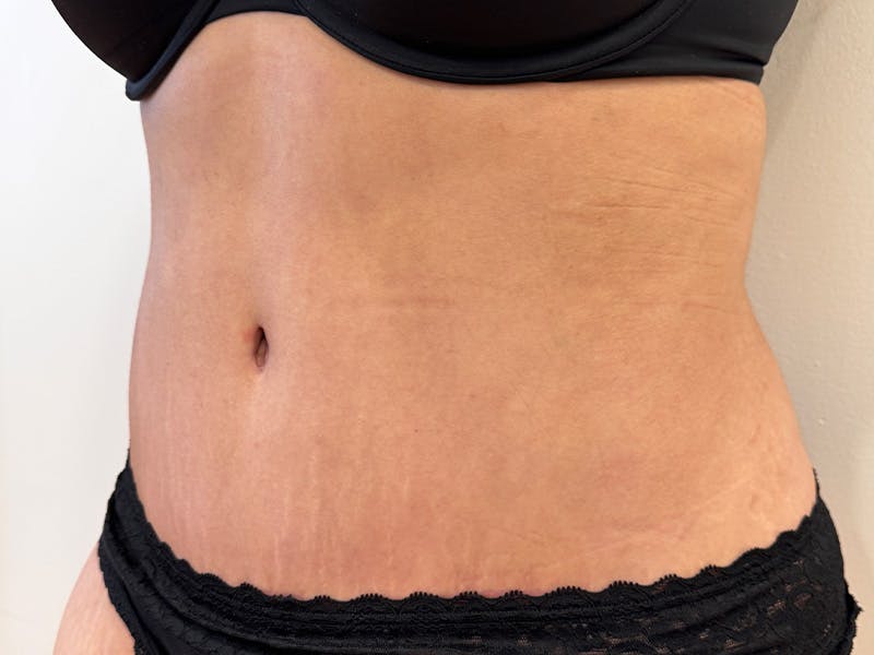 Tummy Tuck Before & After Gallery - Patient 271350 - Image 6