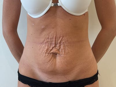 Tummy Tuck Before & After Gallery - Patient 247488 - Image 1