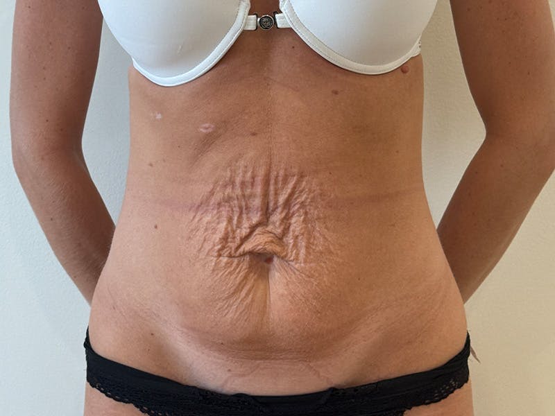 Tummy Tuck Before & After Gallery - Patient 247488 - Image 1