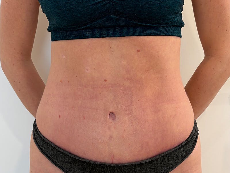 Tummy Tuck Before & After Gallery - Patient 247488 - Image 2