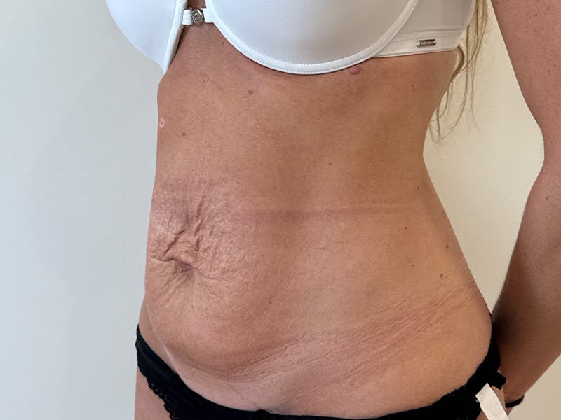 Tummy Tuck Before & After Gallery - Patient 247488 - Image 3