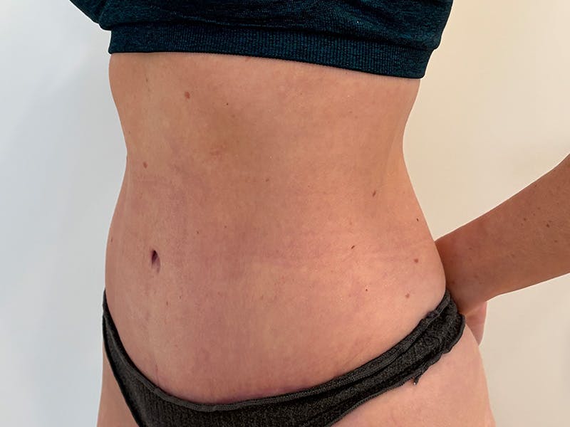 Tummy Tuck Before & After Gallery - Patient 247488 - Image 4