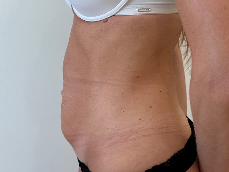 Tummy Tuck Before & After Gallery - Patient 247488 - Image 5