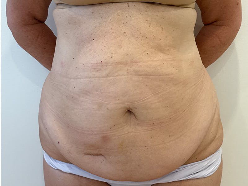 Tummy Tuck Before & After Gallery - Patient 176391 - Image 1