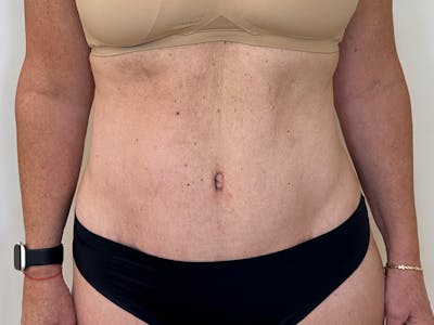 Tummy Tuck Before & After Gallery - Patient 176391 - Image 2
