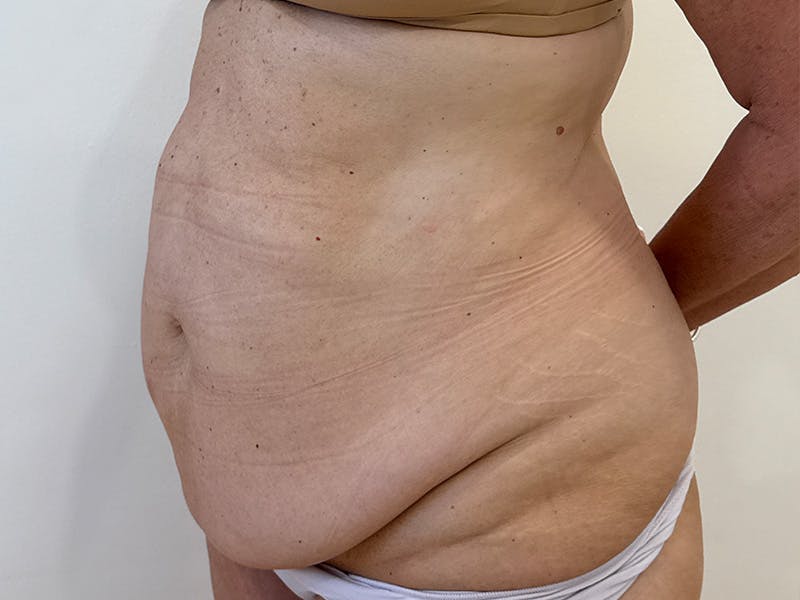 Tummy Tuck Before & After Gallery - Patient 176391 - Image 3