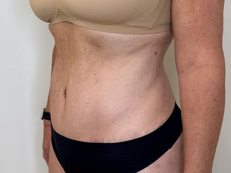 Tummy Tuck Before & After Gallery - Patient 176391 - Image 4