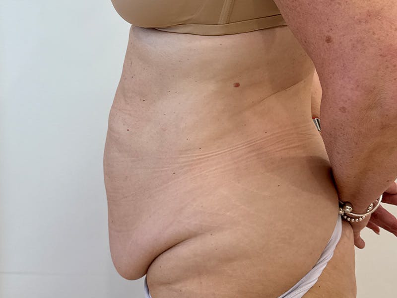Tummy Tuck Before & After Gallery - Patient 176391 - Image 5