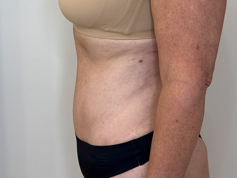 Tummy Tuck Before & After Gallery - Patient 176391 - Image 6