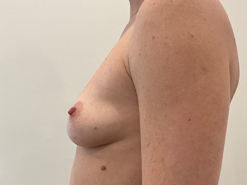 Breast Augmentation Before & After Gallery - Patient 271801 - Image 5