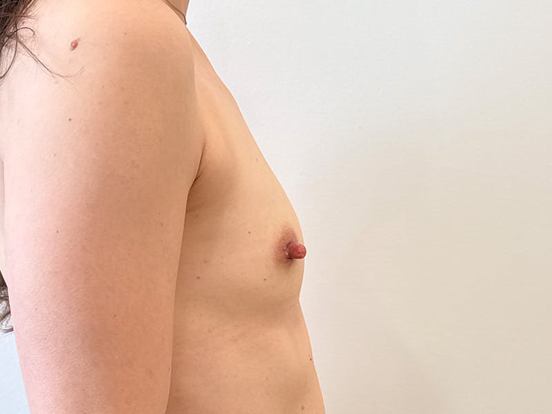 Breast Augmentation Before & After Gallery - Patient 282437 - Image 5