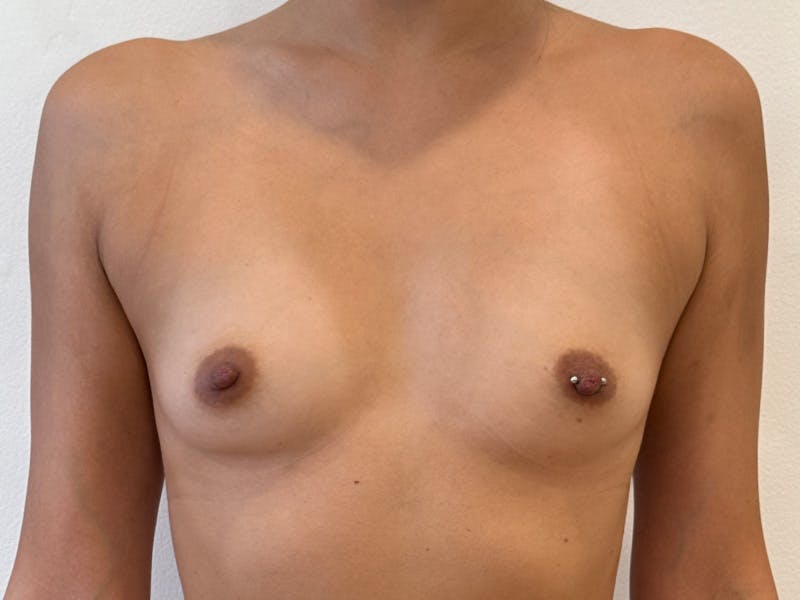 Breast Augmentation Before & After Gallery - Patient 346898 - Image 1