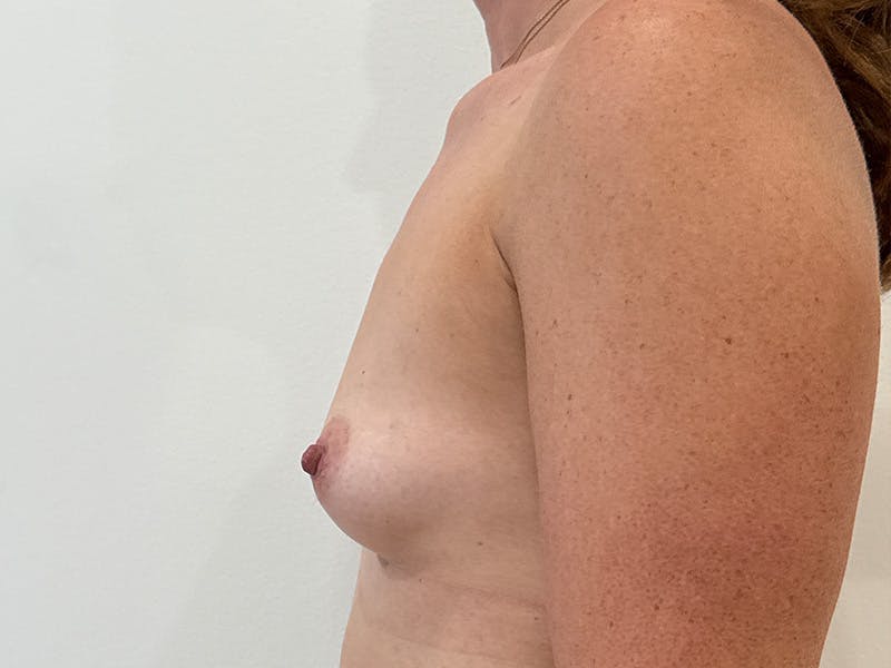 Breast Augmentation Before & After Gallery - Patient 595522 - Image 5