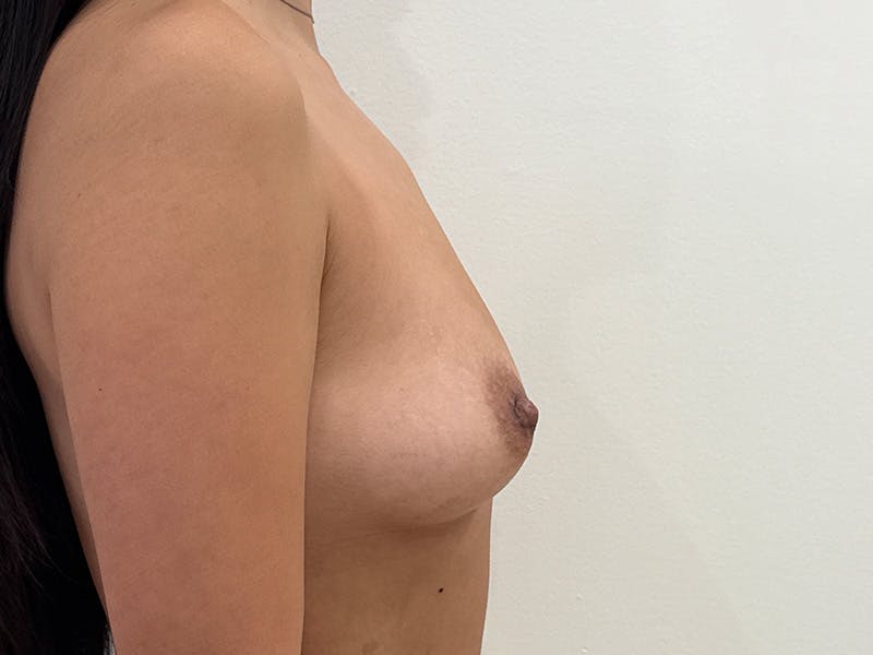 Breast Augmentation Before & After Gallery - Patient 337506 - Image 5