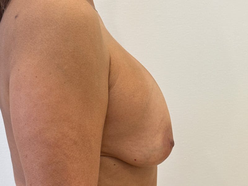 Revision Breast Augmentation  Before & After Gallery - Patient 790952 - Image 5
