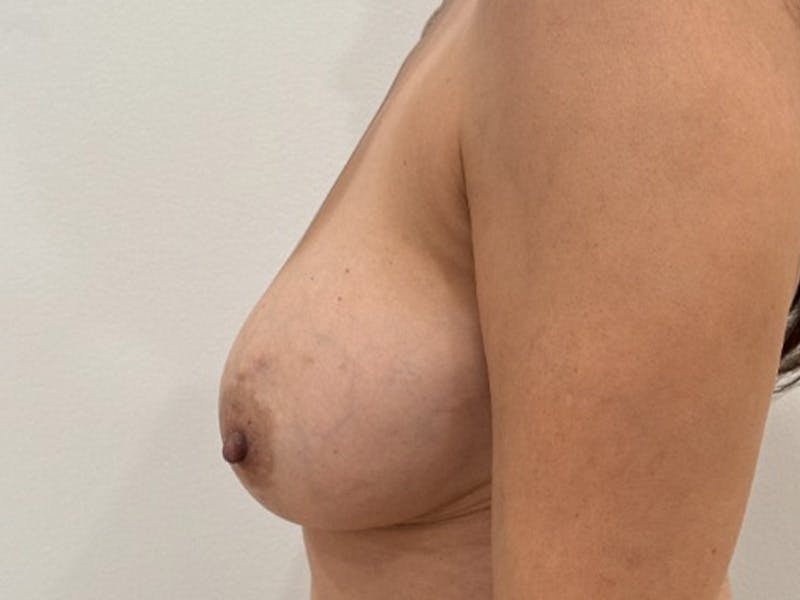 Revision Breast Augmentation  Before & After Gallery - Patient 414984 - Image 5