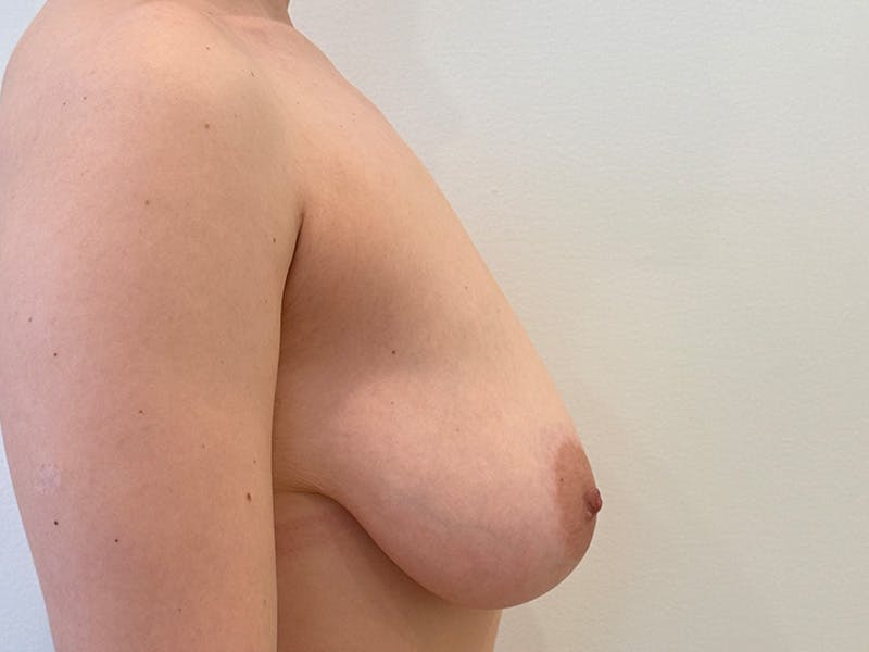 Breast Lift Before & After Gallery - Patient 343951 - Image 5