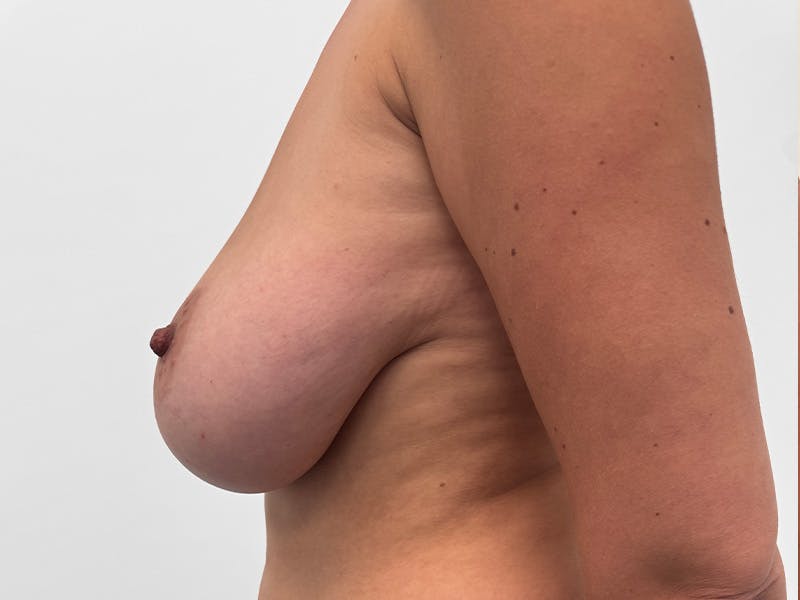 Breast Lift Before & After Gallery - Patient 337039 - Image 5