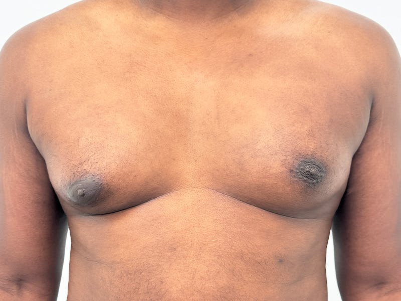 Gynecomastia Before & After Gallery - Patient 336838 - Image 1