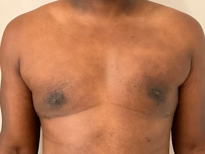 Gynecomastia Before & After Gallery - Patient 336838 - Image 2