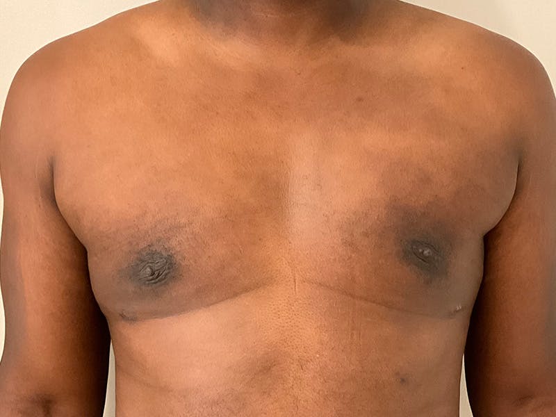 Gynecomastia Before & After Gallery - Patient 336838 - Image 2
