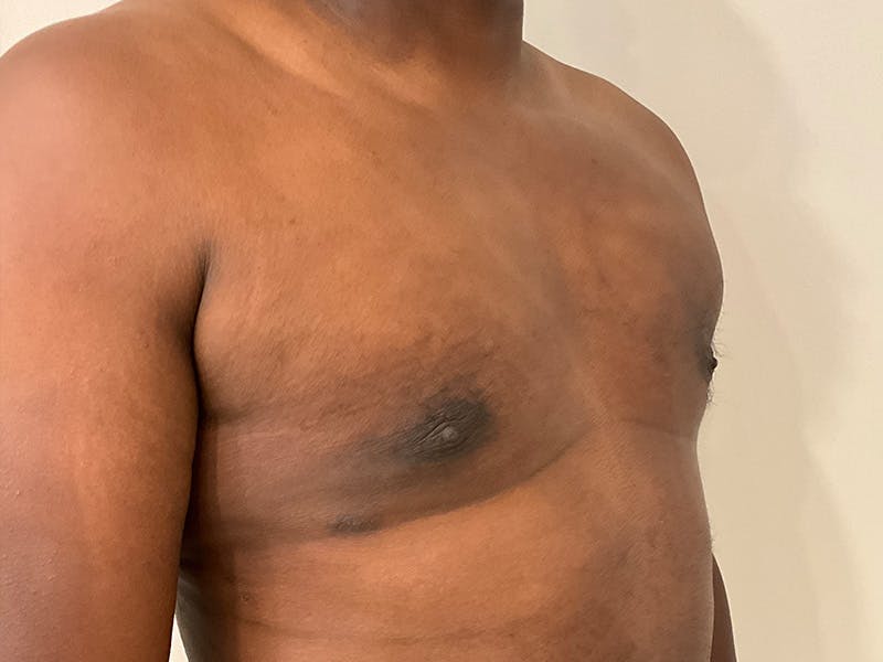 Gynecomastia Before & After Gallery - Patient 336838 - Image 4