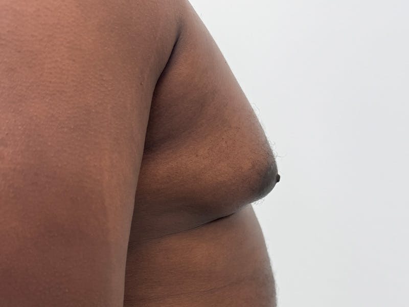 Gynecomastia Before & After Gallery - Patient 336838 - Image 5