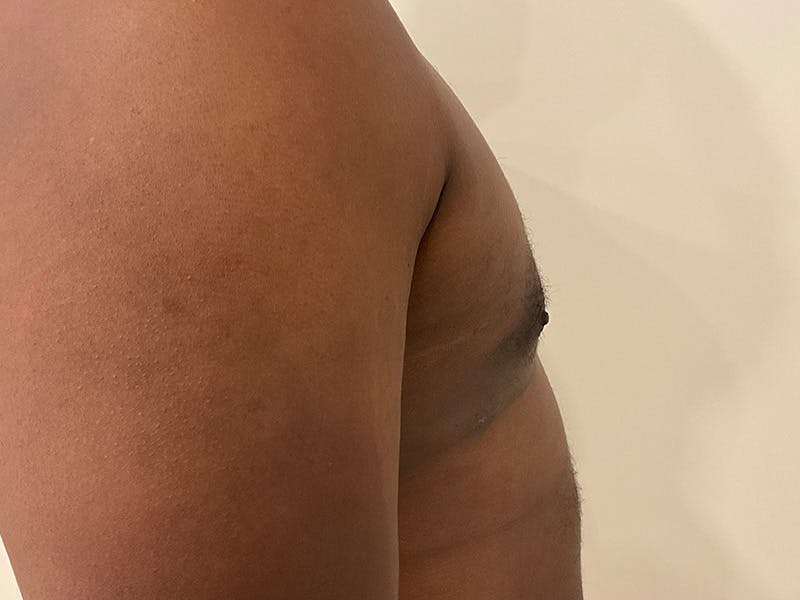 Gynecomastia Before & After Gallery - Patient 336838 - Image 6