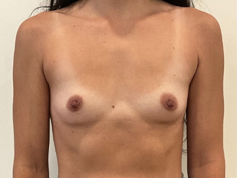 Breast Augmentation Before & After Gallery - Patient 345623 - Image 1