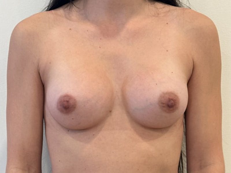 Breast Augmentation Before & After Gallery - Patient 345623 - Image 2