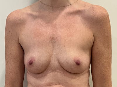 Breast Augmentation Before & After Gallery - Patient 641200 - Image 1