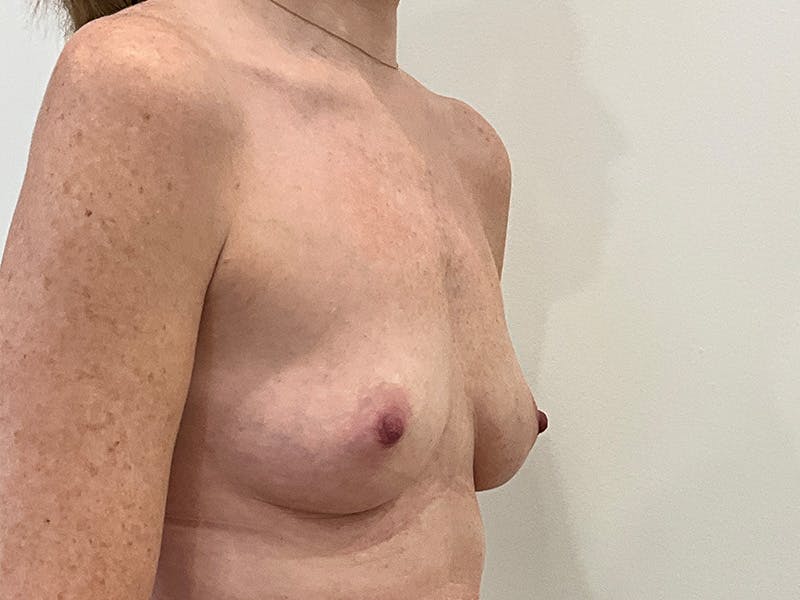 Breast Augmentation Before & After Gallery - Patient 154001 - Image 3