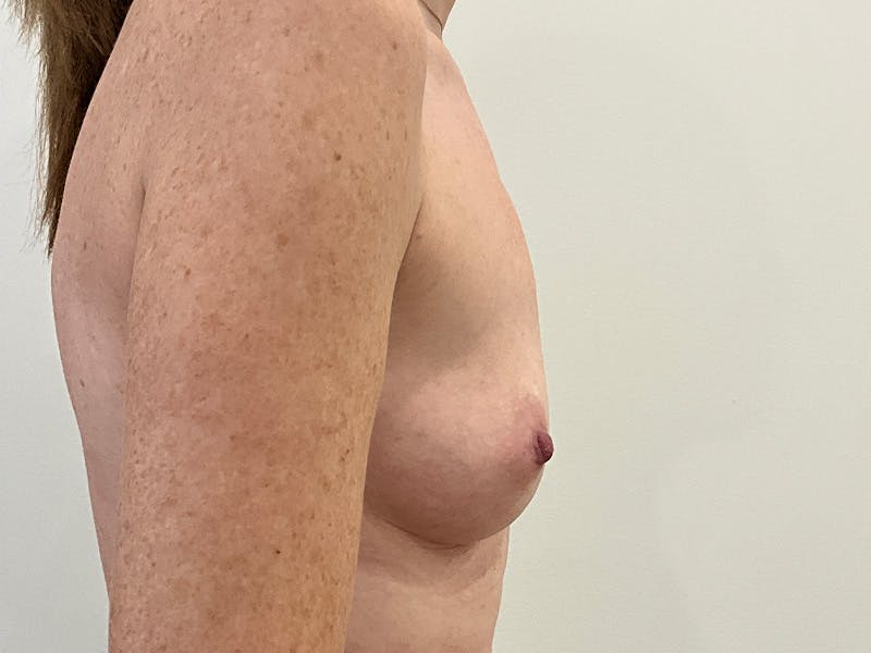 Breast Augmentation Before & After Gallery - Patient 154001 - Image 5