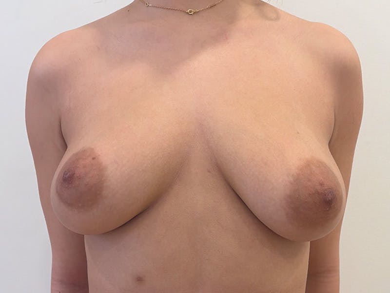Breast Augmentation and Lift Before & After Gallery - Patient 342916 - Image 1