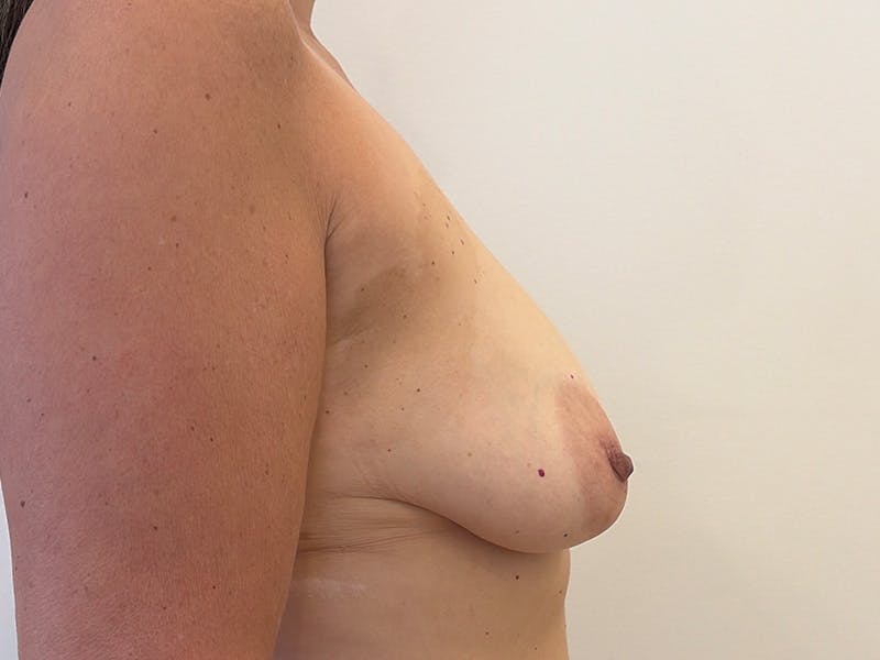 Breast Lift Before & After Gallery - Patient 157322 - Image 5