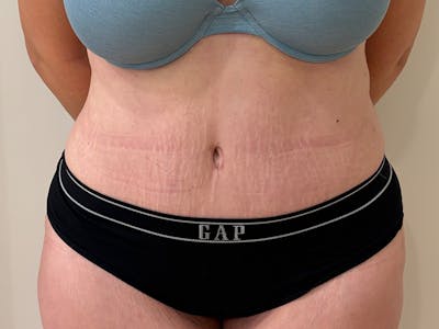 Tummy Tuck Before & After Gallery - Patient 266744 - Image 2