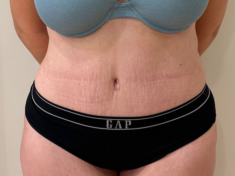 Tummy Tuck Before & After Gallery - Patient 266744 - Image 2